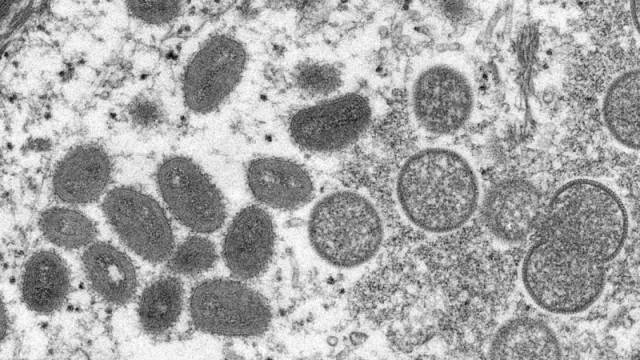 Ministério da Saúde confirma nono caso de monkeypox no país