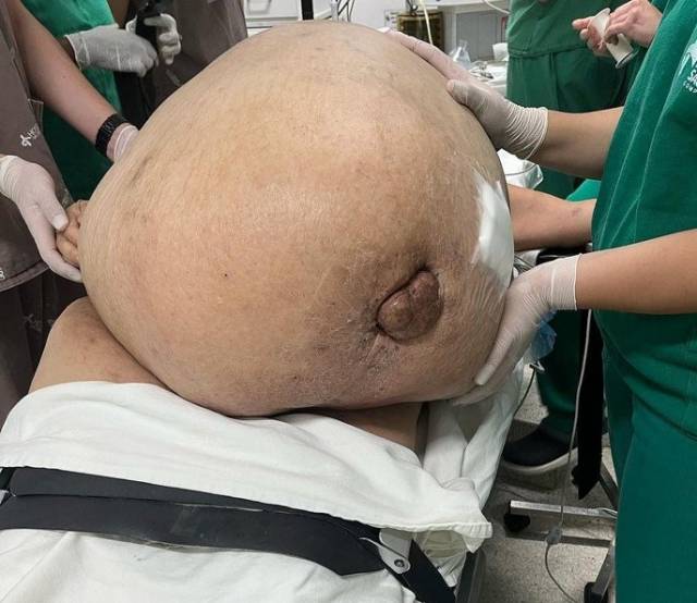 Médicos retiram tumor de 46 quilos de paciente que tinha câncer há 5 anos sem saber