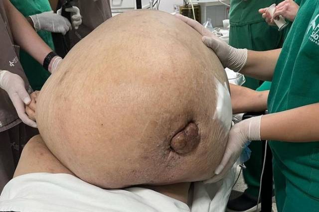Morre mulher que teve tumor de 46 kg retirado em cirurgia de emergência